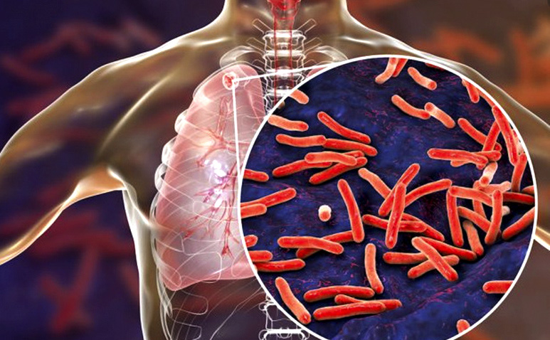 Landmark moment: AI beats humans in reading X-rays for TB