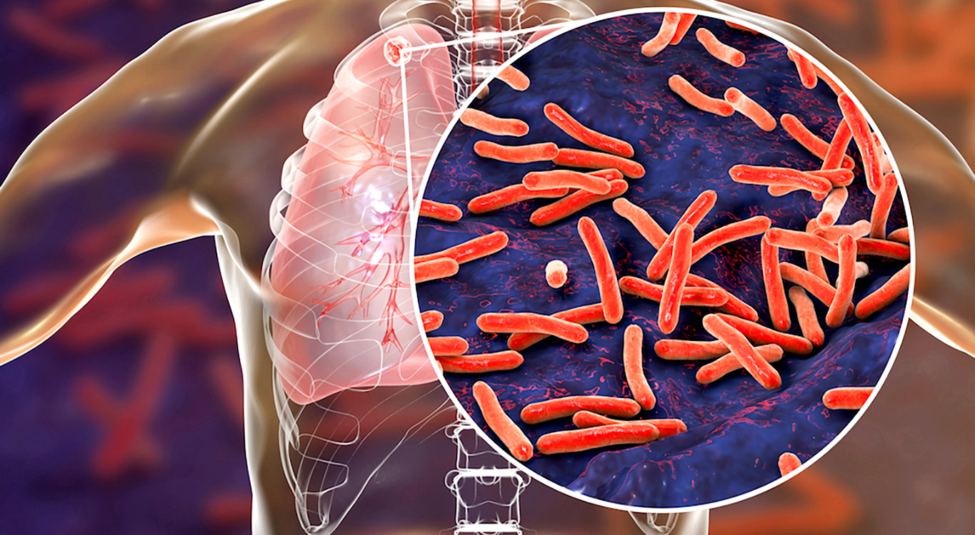 Shorter treatment regimens for TB offer hope but need urgent implementation