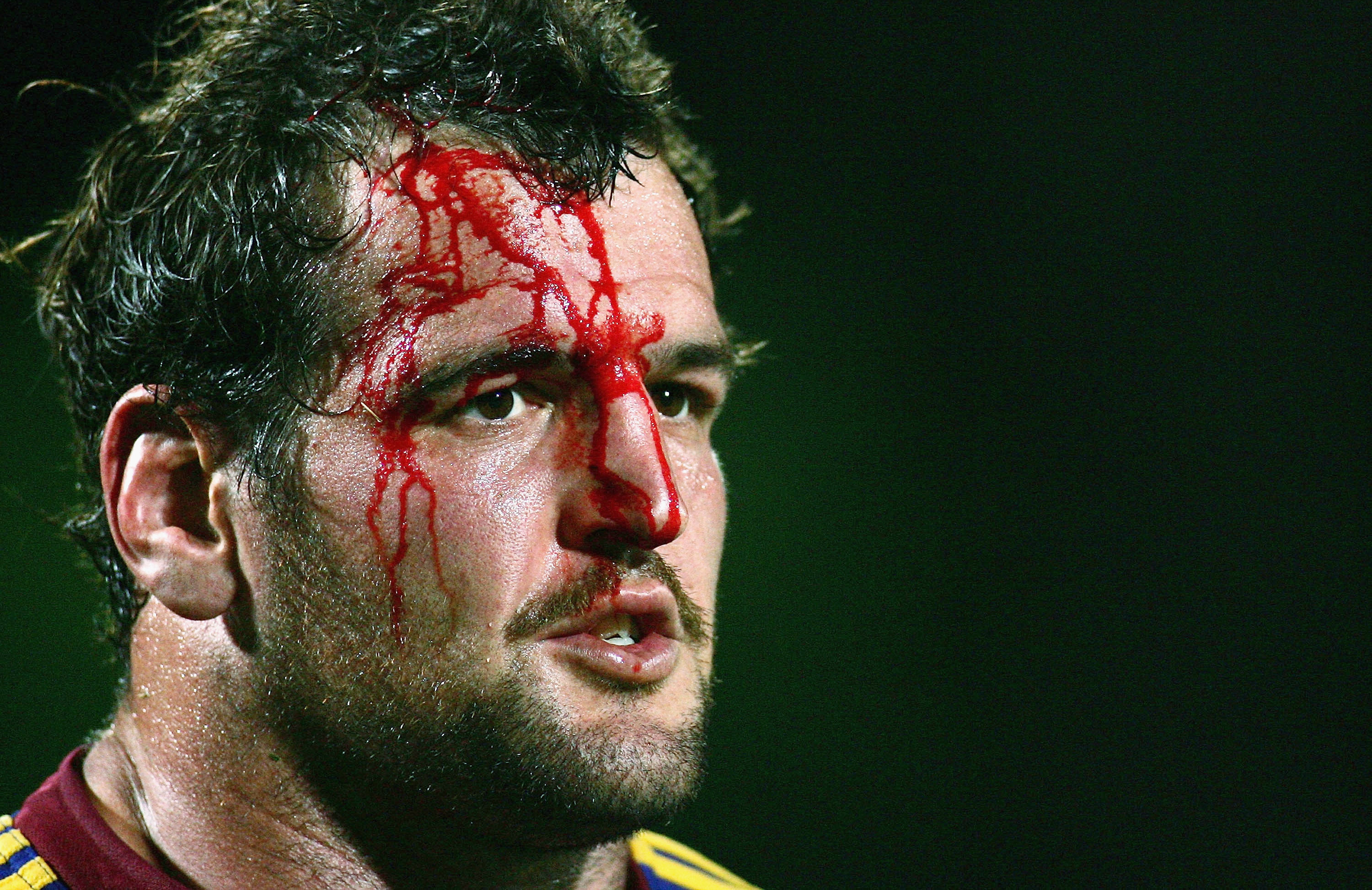 International expert panel revises concussion protocols to mitigate against harmful consequences