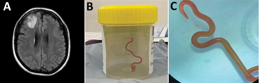Ophidascaris robertsi roundworm found alive in Australian woman's brain