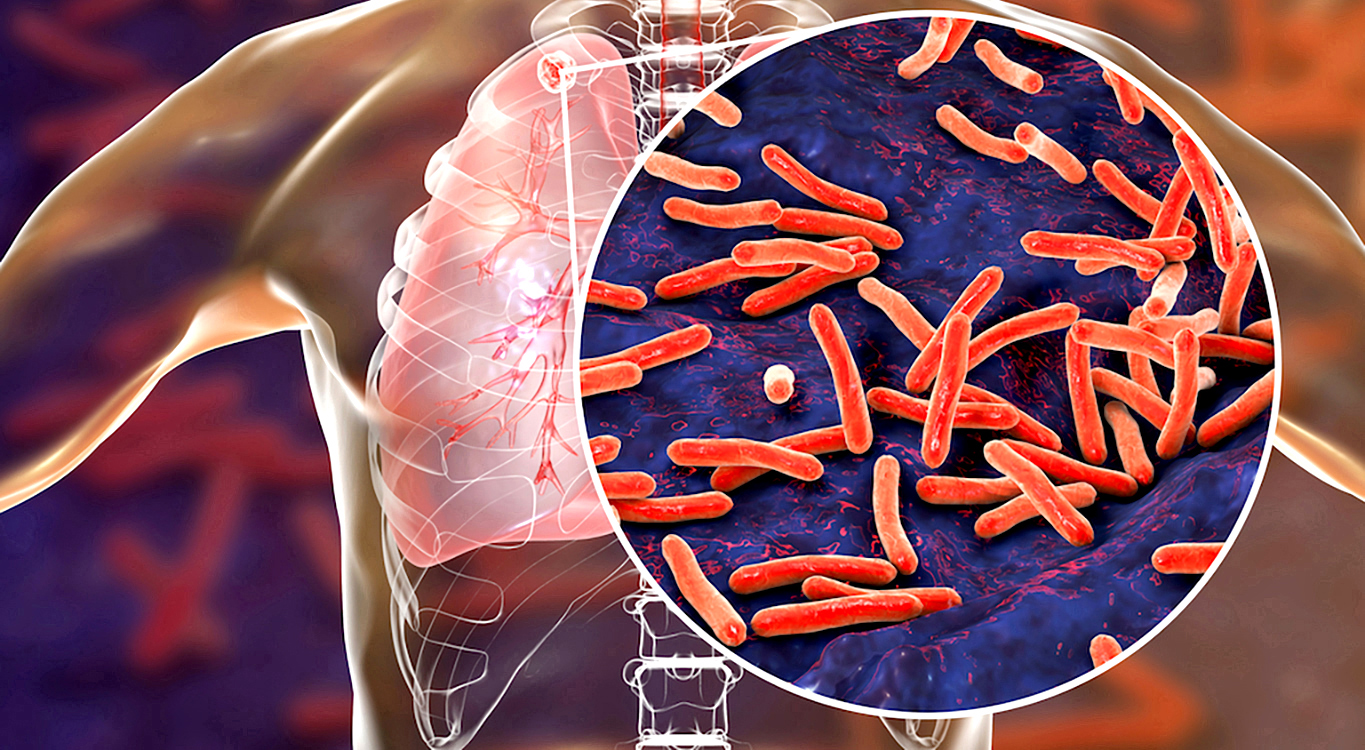 Can CO2 monitors help protect healthcare workers from TB?