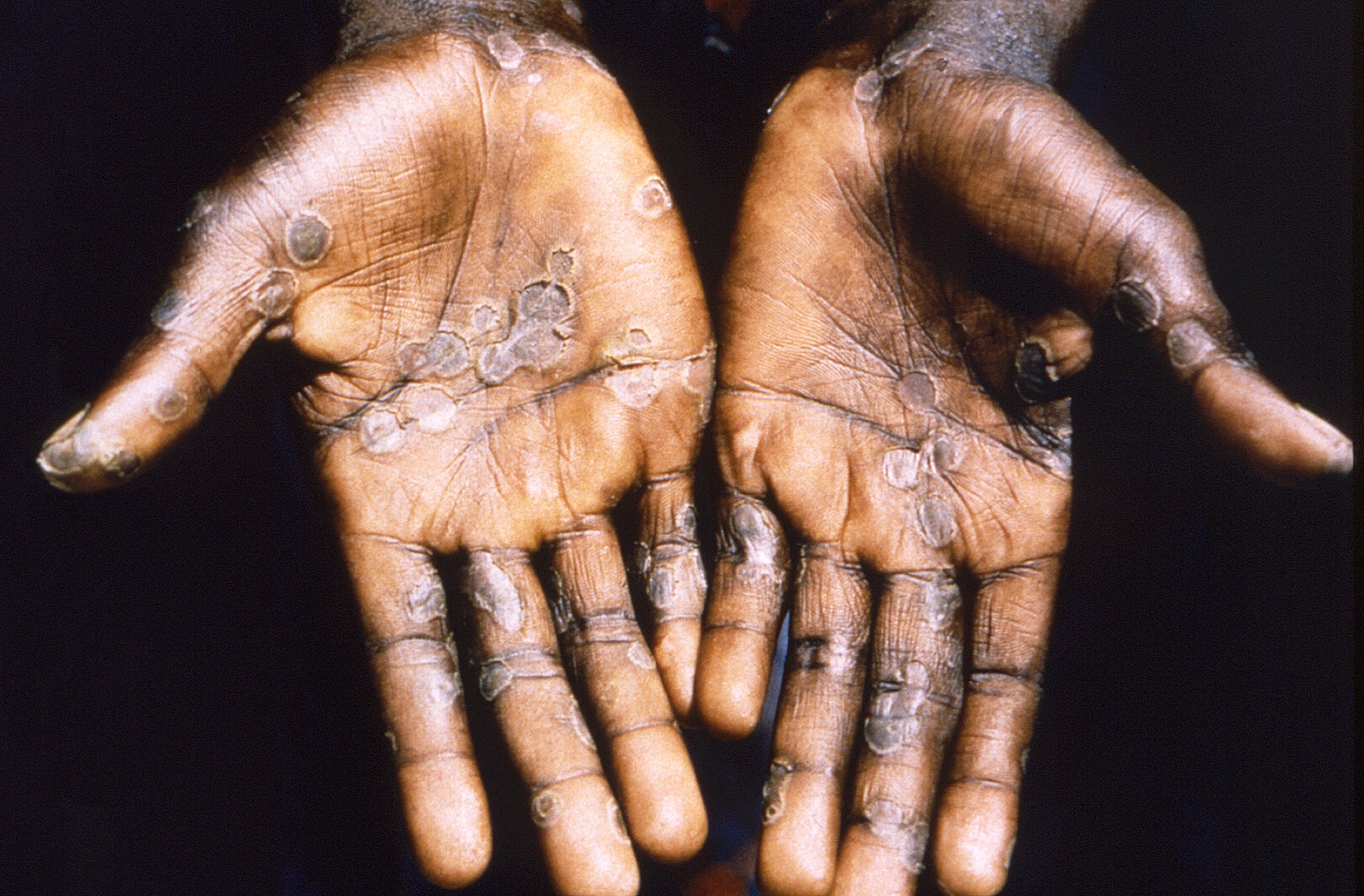 Mpox outbreak in Africa was neglected, and could now turn into the next global pandemic