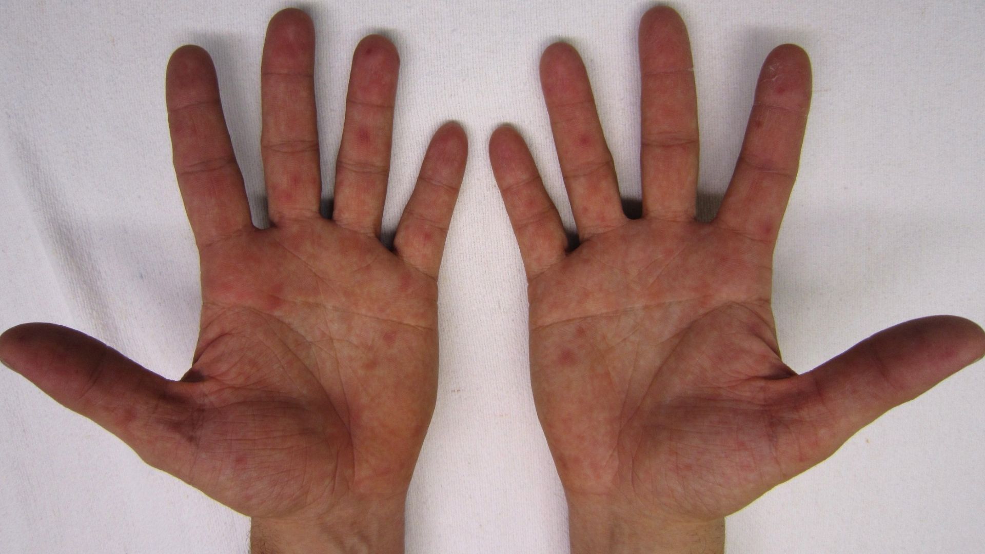 ‘No need to panic’ amid KZN surge in hand-foot-and-mouth disease