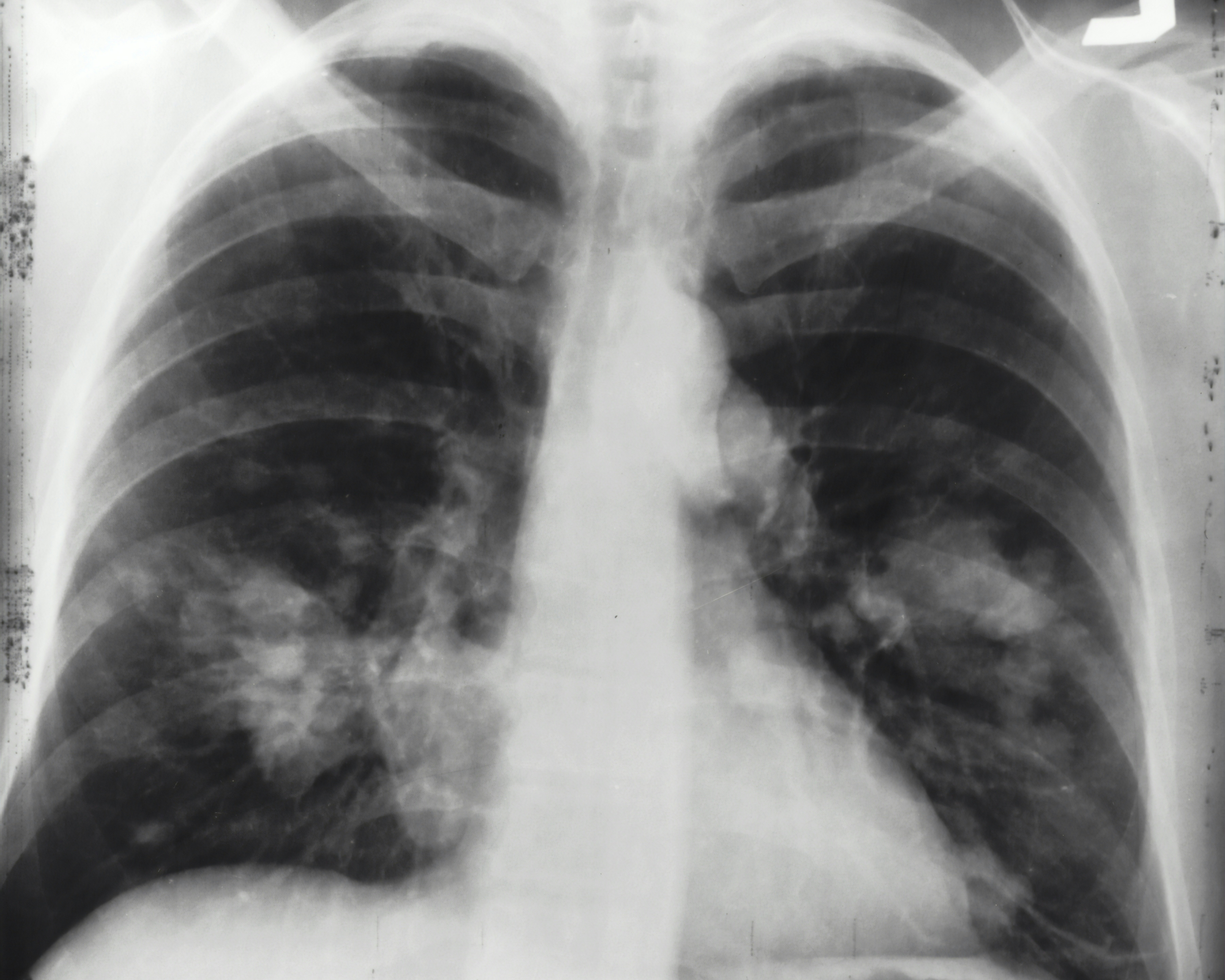 Why is there an increase in lung cancer among women who have never smoked?