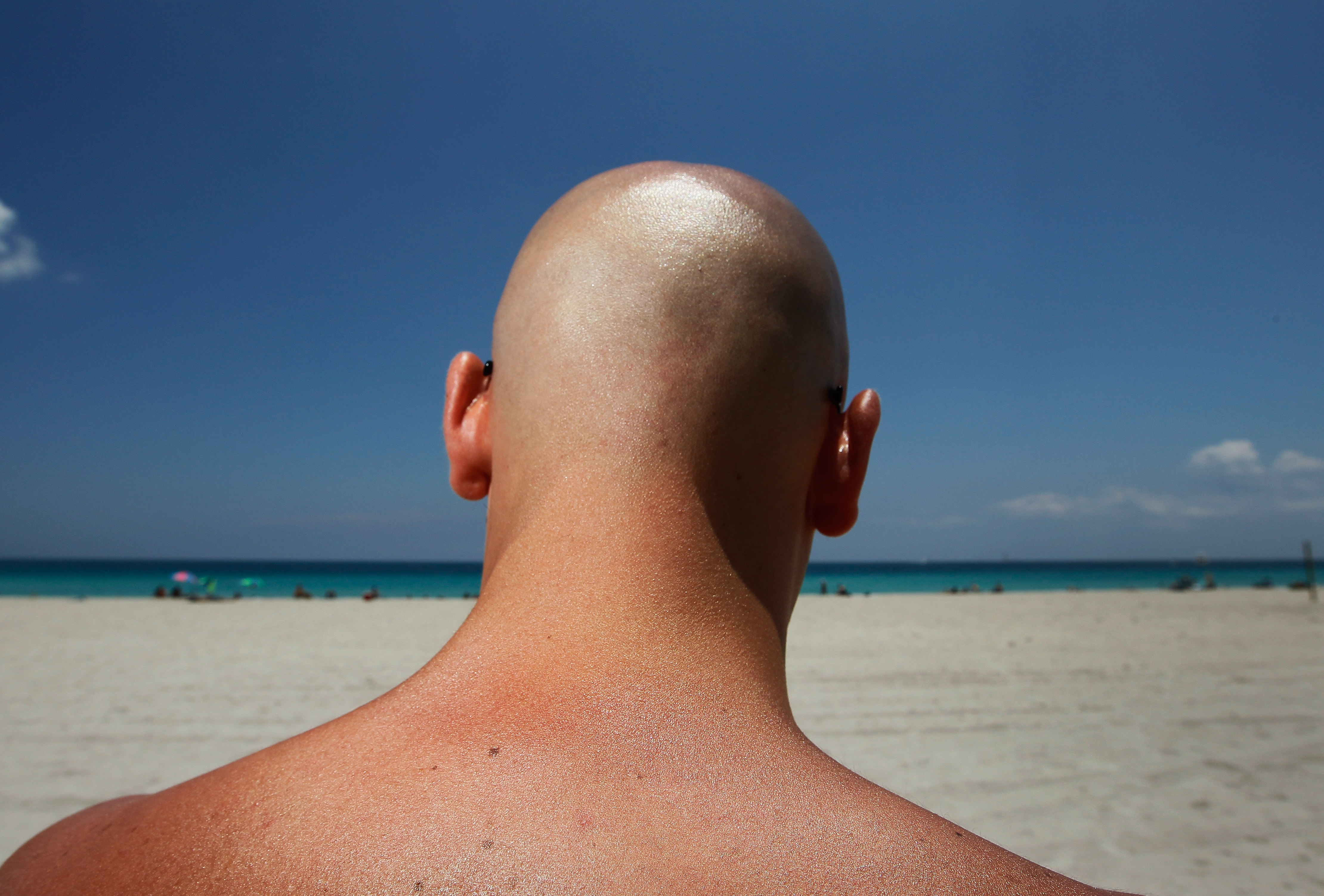 What’s the difference between freckles, sunspots and moles?