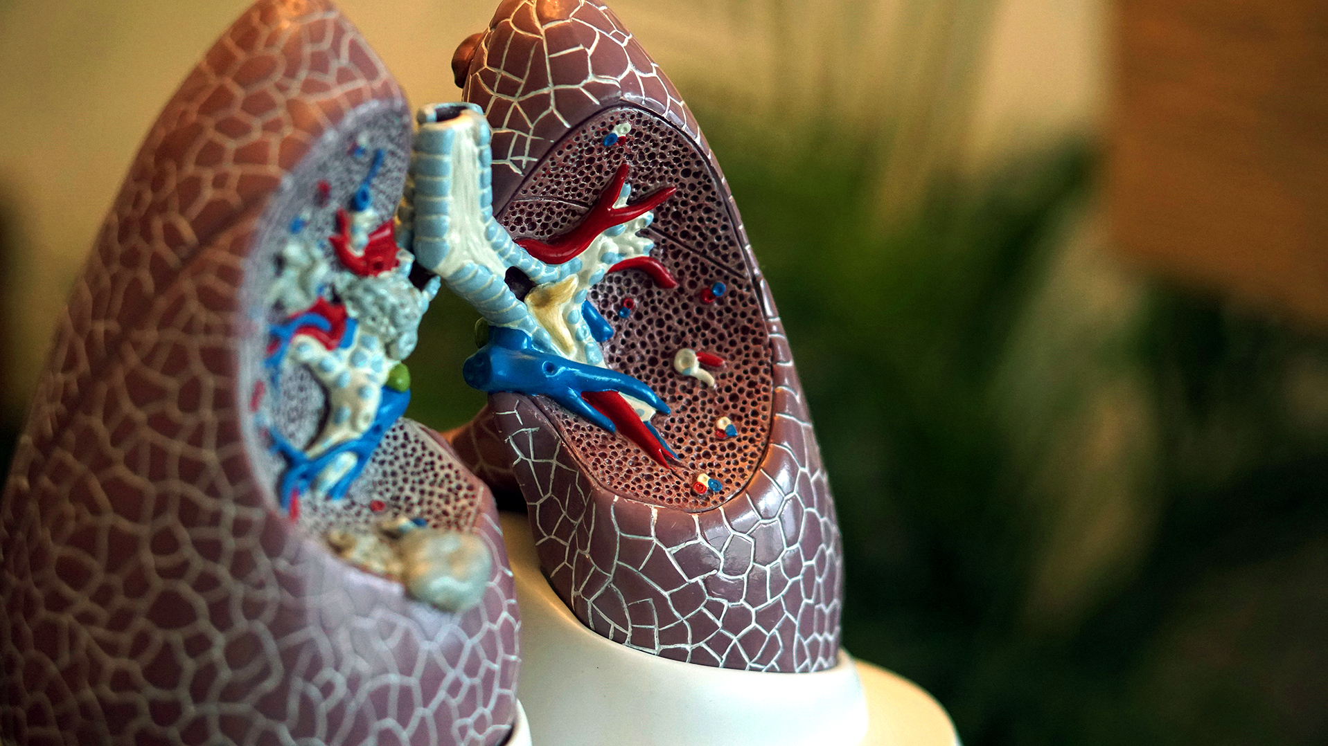 Post-TB lung disease a hidden crisis that affects millions, yet remains ignored