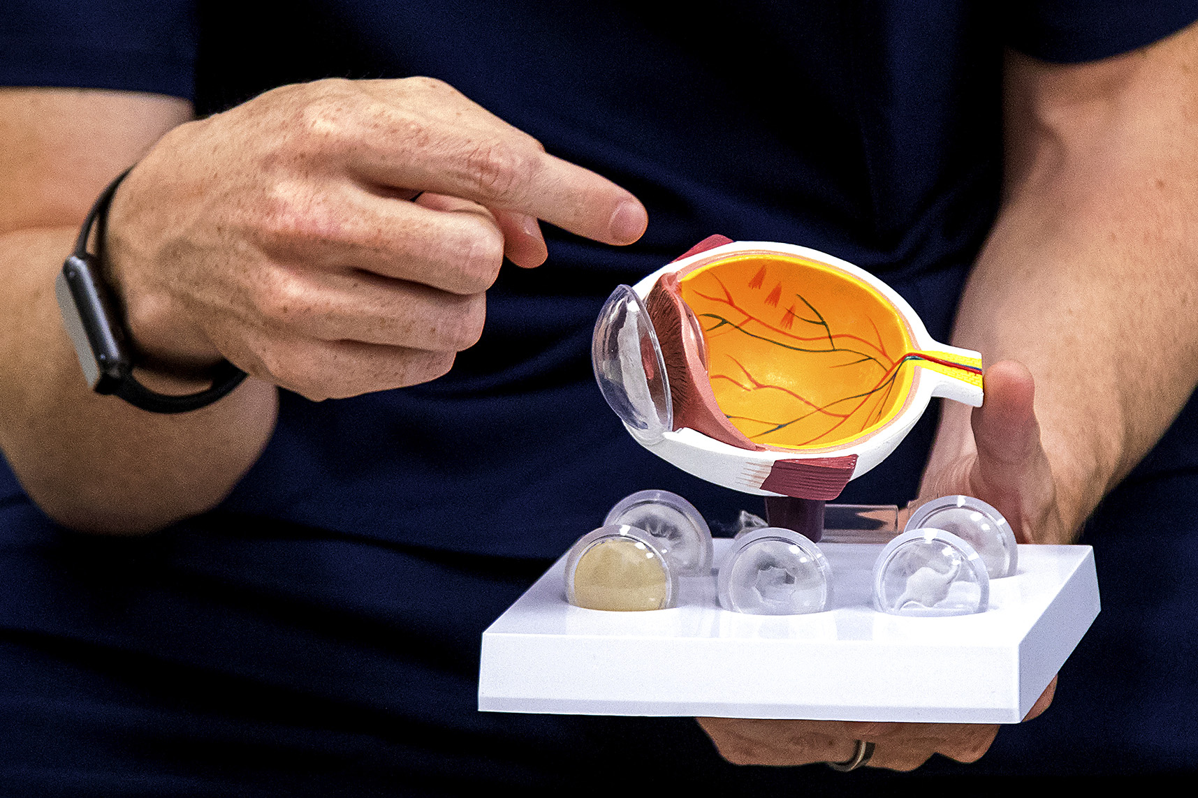 Keratoconus is not a life sentence — helping give back the gift of sight