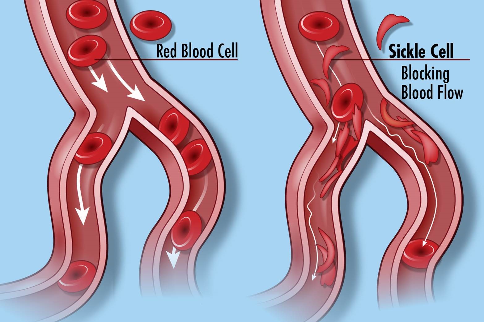 UCT professor’s research offers hope of treatment for sickle cell anaemia