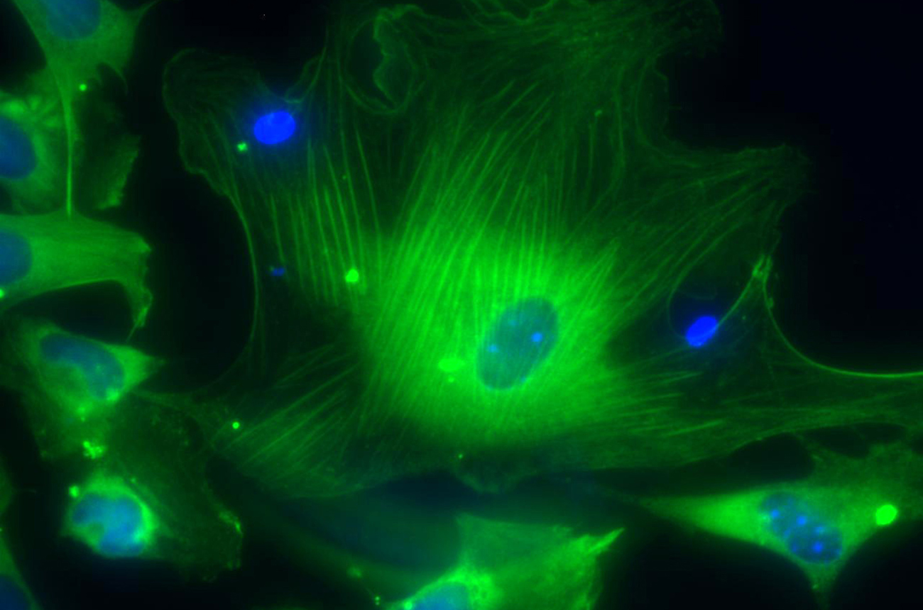 Japan human trial tests iPS cell treatment for Parkinson's
