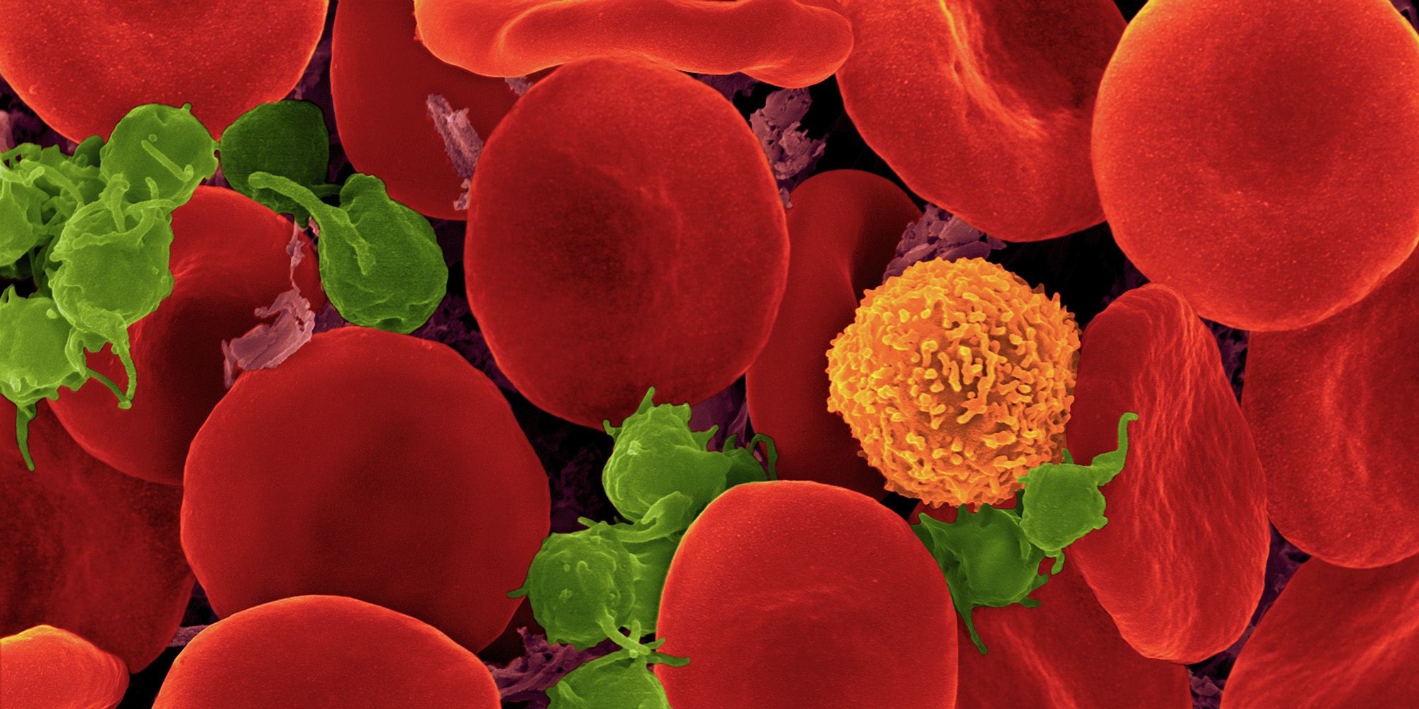 Second person free from HIV after stem cell transplant