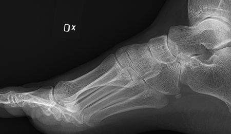 Spotlight: Orthopaedic nightmare in the Free State