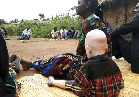Tanzanians hard hit by murderous trade in trafficking in people with albinism