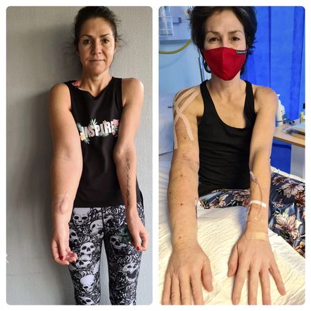 Life-altering lymphoedema surgery brought to SA