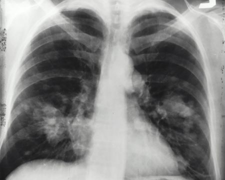 Why is there an increase in lung cancer among women who have never smoked?