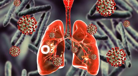 Fight against TB is gaining ground in SA, but there’s a long way to go, say scientists