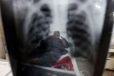 'Game changer' tuberculosis drug cures 9 in 10