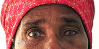 Gauteng has a confirmed backlog for cataract operations of almost 14,000 people, although some ophthalmologists believe that due to Covid-19 disruptions, the number may be at least triple this. (Photo: Rosetta Msimango / Spotlight)