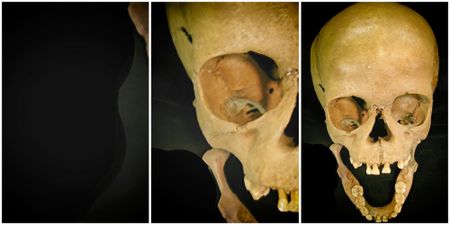 What killed Ballito Boy some 2,000 years ago, and why this is relevant today