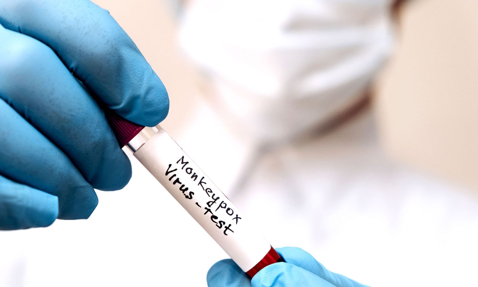Second monkeypox case identified in South Africa