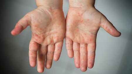 Gauteng Department of Health intensifies public health response following rise in measles cases