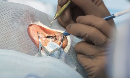 Cataract surgeries are backing up in the Western Cape, but it’s not a new problem