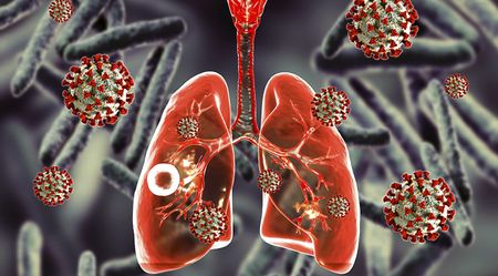 Government reveals plans to restore TB services in South Africa