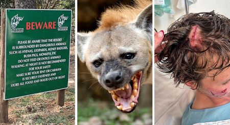 Previous hyena attack victim describes Cape Vidal ordeal that left him needing reconstructive surgery
