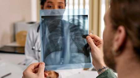 A R60 test could help SA find millions more TB patients — but will it miss the most dangerous cases?
