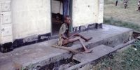 A severely malnourished person in a refugee camp near the Nigerian-Biafran war zone in late 1960s. (Photo: Public Health Image Library)