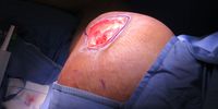 The bedsore just before the surgeons started operating. The area is on the upper left thigh, on the side, and about 10 cm x 15 cm. (Photo: Elsabé Brits)