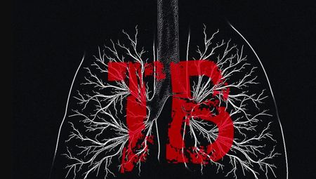 What the new WHO TB numbers mean for South Africa