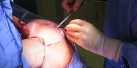 The result: The doctors are still busy with the stitching, but the result can be seen, compared with the open bedsore from hours before. (Photo: Elsabé Brits)